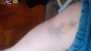 So sieht übrigens das Knie vom Mausebären heute aus